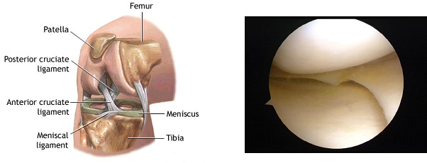 Meniscal Surgery