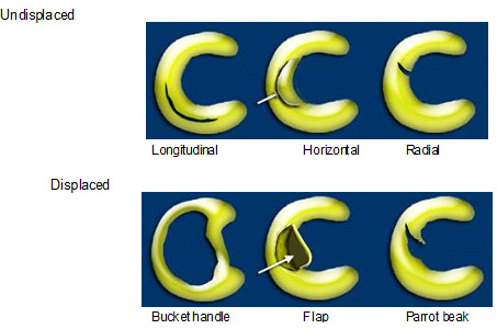 Meniscal Surgery