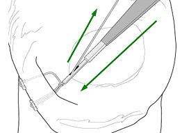 Meniscal Surgery
